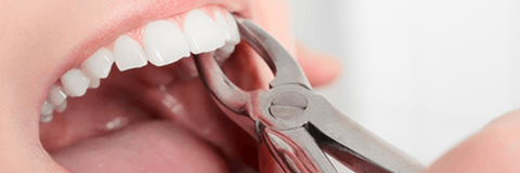 قلع الأسنان بالجراحة أو طبيعيا